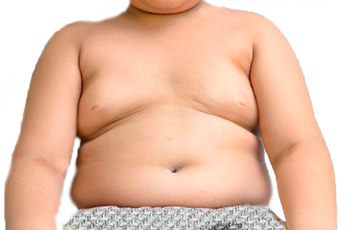 obesidade-infantil

